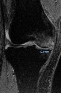 Stage 1 大腿骨顆部骨壊死MRI