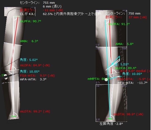 ｍediCADによる術前計画