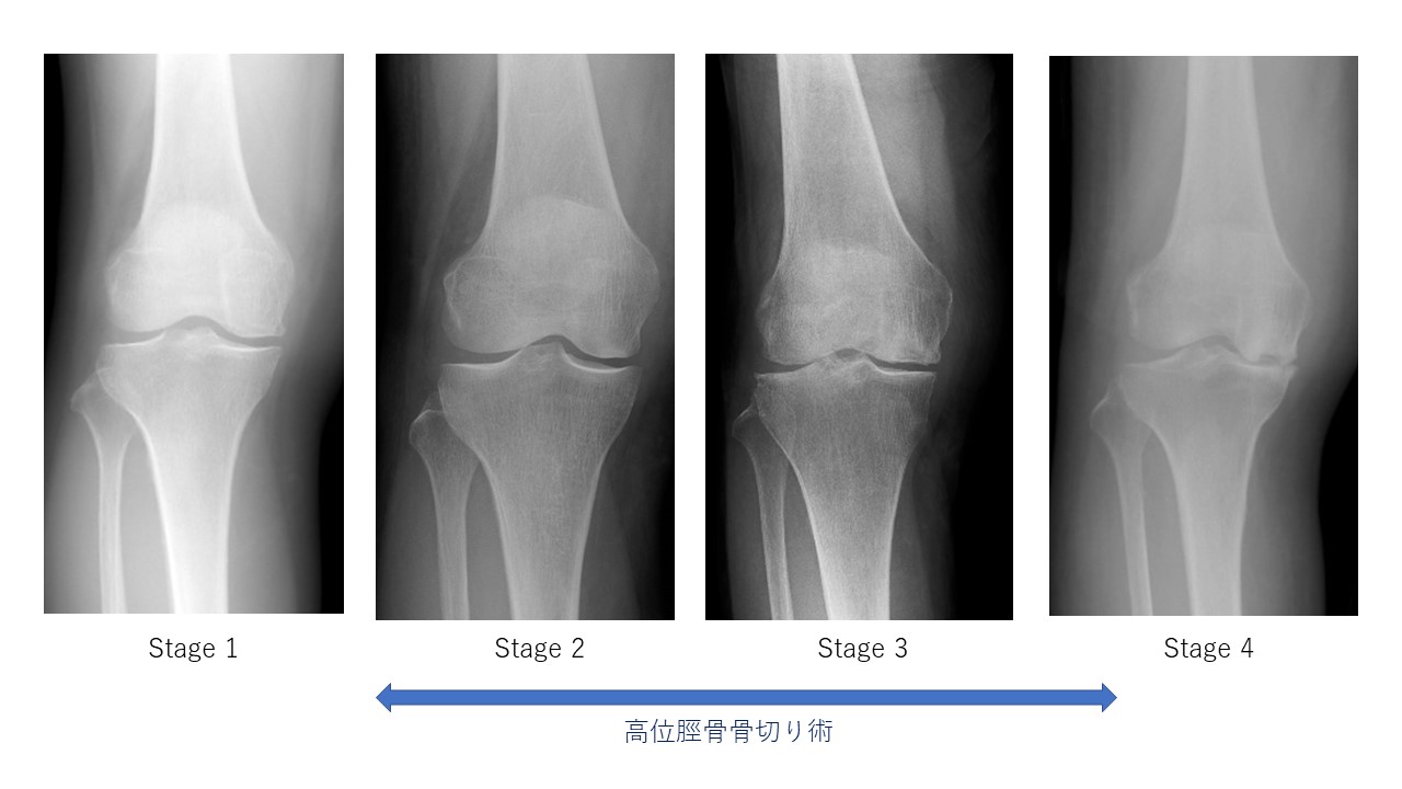 特発性大腿骨顆部骨壊死レントゲンStage分類と高位脛骨骨切り術