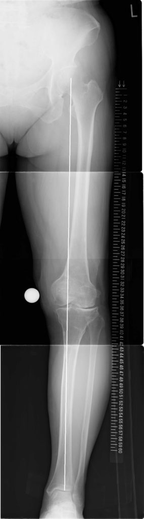 外側型変形性膝関節症手術後Xp