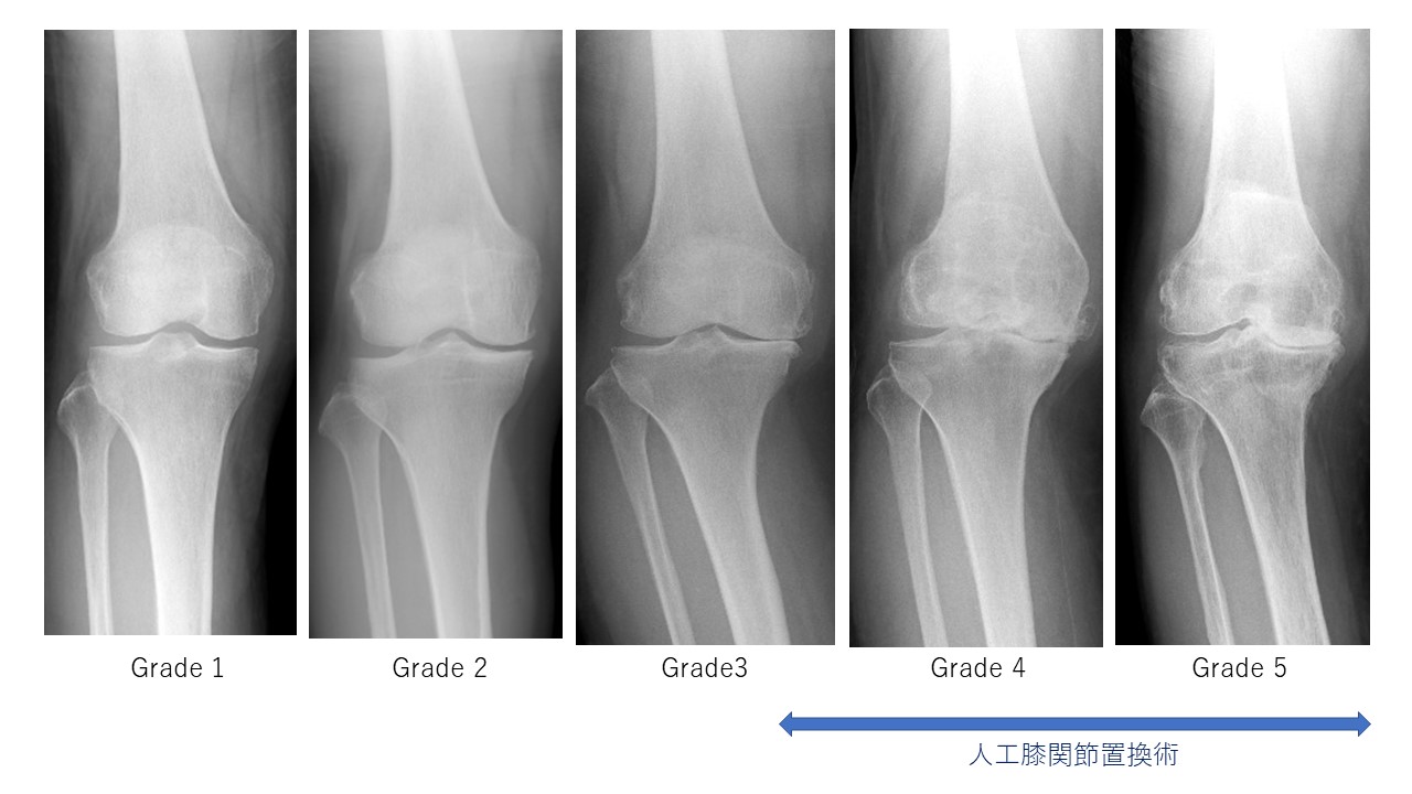 人工膝関節置換術の適応