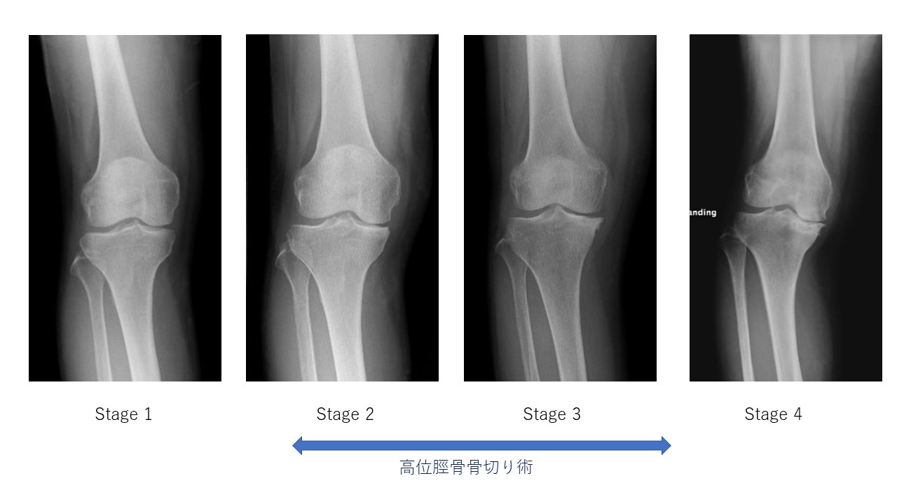 特発性脛骨顆部骨壊死レントゲンStage分類と高位脛骨骨切り術