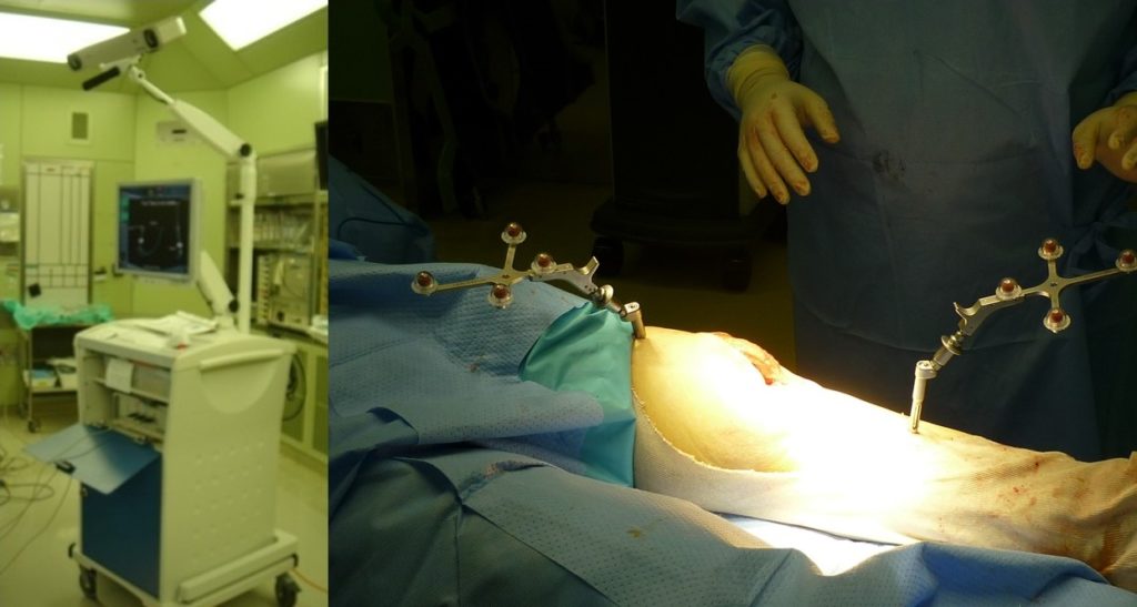 ナビゲーション人工膝関節置換術 | 高位脛骨骨切り術｜膝周囲骨