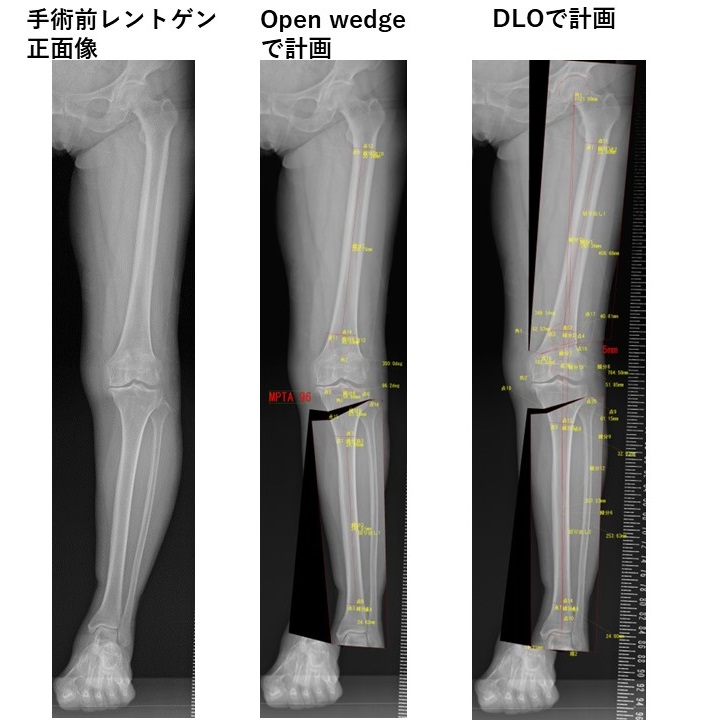 DLO術前計画