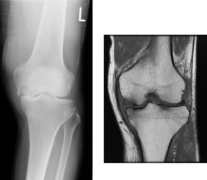 特発性膝骨壊死手術前XpMRI2