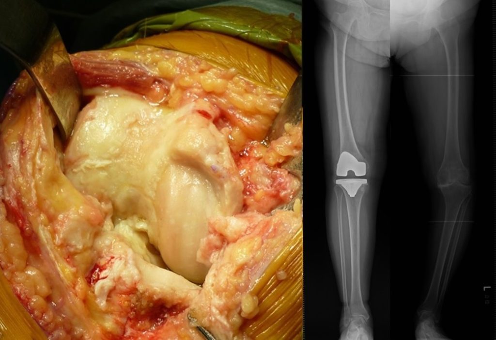 人工膝関節置換術右手術中写真と手術後Xp