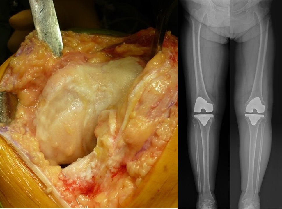 人工膝関節置換術左手術中写真と両側手術後Xp