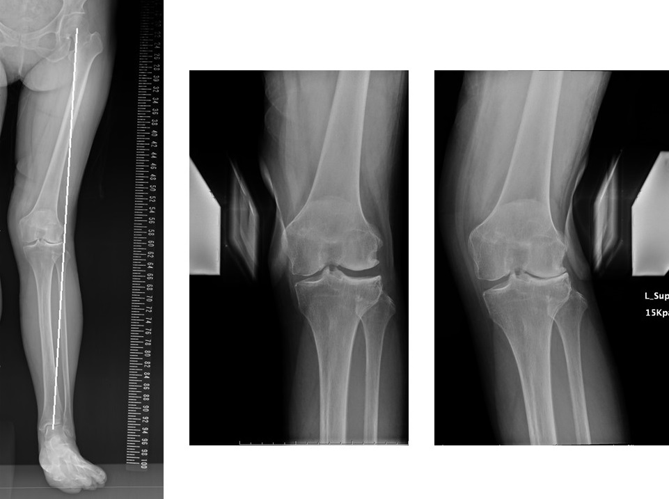 外側型変形性膝関節症手術前Xp