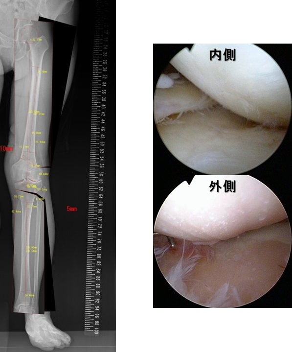 外側型変形性膝関節症術前計画と手術中関節鏡所見